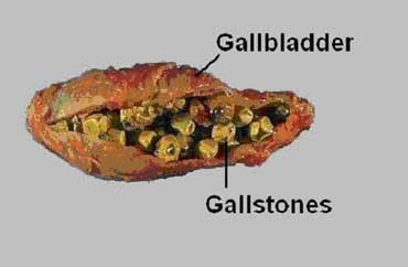 gallstones_370