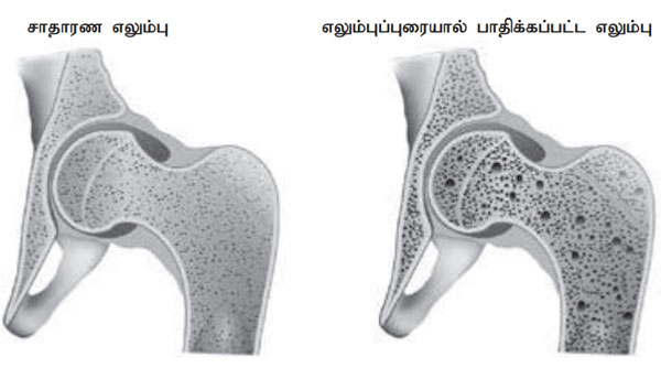 bone fracture 600