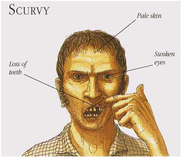 scurvy_370